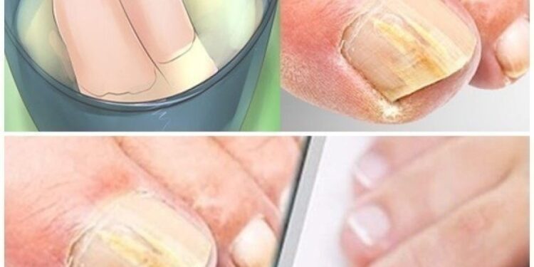 Nagelpilz mit diesen Hausmitteln beseitigen