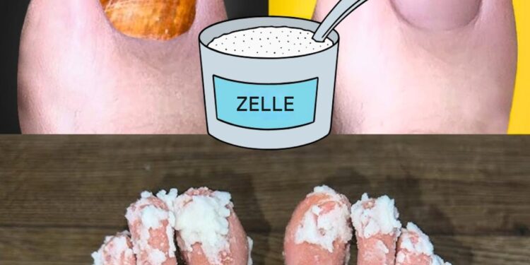 Wenn Sie Nagelpilz haben, versuchen Sie dieses natürliche Heilmittel