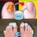 Wenn Sie Nagelpilz haben, versuchen Sie dieses natürliche Heilmittel