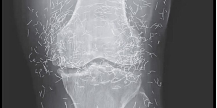 Auf dem Röntgenbild der Knie einer Frau sind Hunderte von Goldnadeln zu sehen