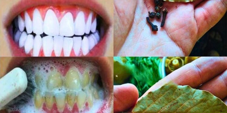 Wie kann man Zähne mit Nelken und Lorbeerblättern aufhellen