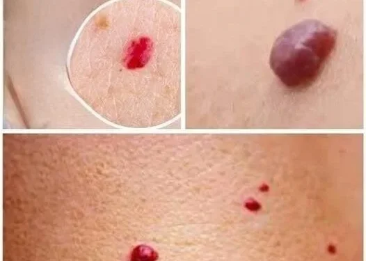 Wenn Sie rote Punkte auf Ihrer Haut entdecken, bedeuten sie Ungünden