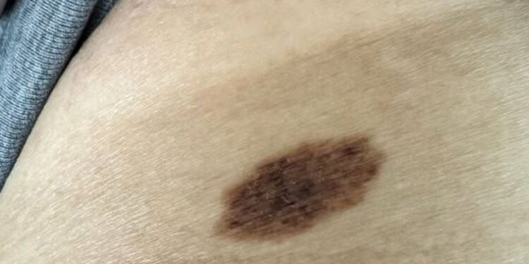 Ich habe diesen Maulwurf mit fleckigen dunklen Flecken. Was soll ich tun?