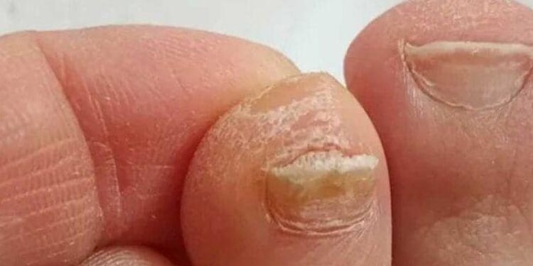 Der Trick zur Reduzierung der Zehennageldicke