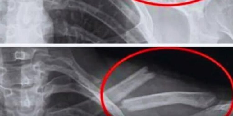 Dieses Getränk zerstört die Knochen, dennoch trinken viele Menschen es täglich