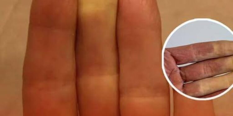 Was es wirklich bedeutet, wenn einer deiner Finger weiß wird, wenn es kalt ist