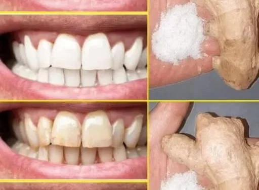 Bleichen Sie Ihre Zähne sofort mit diesem 2-minütigen Ingwer-Salz-Trick auf. So geht’s