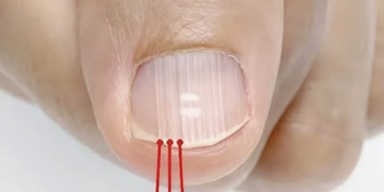 Was die vertikalen Linien auf Ihren Nägeln wirklich verratenn