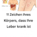 Anzeichen dafür, dass Ihre Leber krank ist