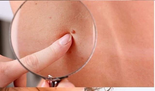 Warum haben Sie rote Muttermale auf Ihrer Haut? Das ist der Grund!!