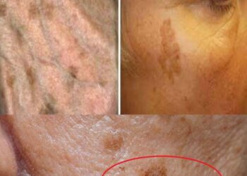 Wenn Sie nicht genug von diesem Mineral haben, ist es wahrscheinlicher, dass Sie Altersflecken haben