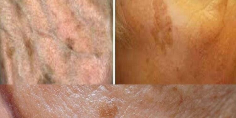 Wenn Sie nicht genug von diesem Mineral haben, ist es wahrscheinlicher, dass Sie Altersflecken haben