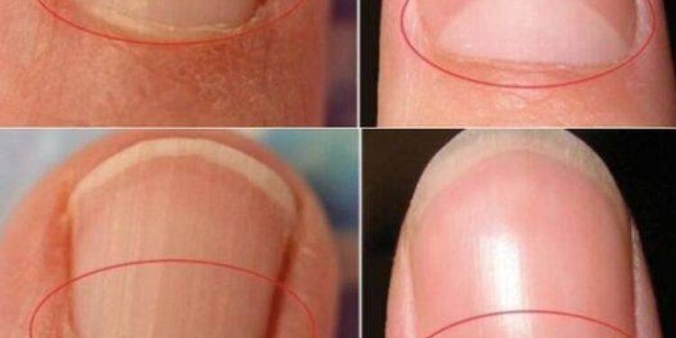 Wenn Ihre Nägel keine Halbmondform haben, suchen Sie sofort einen Arzt auf