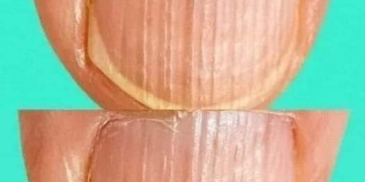 Geriffelte Fingernägel enthüllen Geheimnisse möglicher Krankheiten