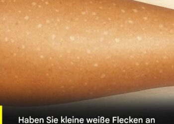 Weiße Flecken auf der Haut: Welche Vitaminmängel könnten die Ursache sein