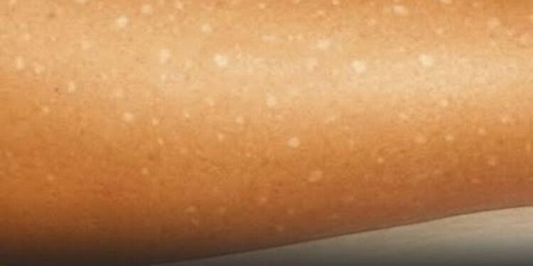 Weiße Flecken auf der Haut: Welche Vitaminmängel könnten die Ursache sein