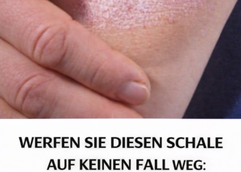 Werfen Sie die Schale dieser Frucht nicht weg: Sie hilft bei der Behandlung von Schuppenflechte, entfernt Warzen und hellt die Zähne auf!